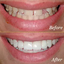 Bridges - Before & After Bridges - Before & After