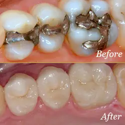 Crowns - Before & After Crowns - Before & After
