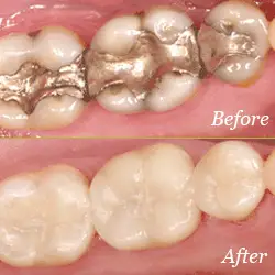 Fillings - Before & After Fillings - Before & After
