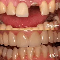 Dental Implants - Before & After Dental Implants - Before & After
