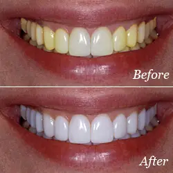 Teeth Whitening - Before & After Teeth Whitening - Before & After