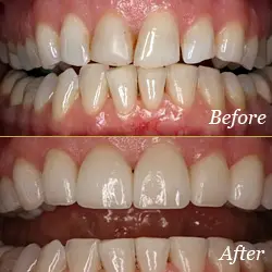 Dental Veneers - Before & After Dental Veneers - Before & After